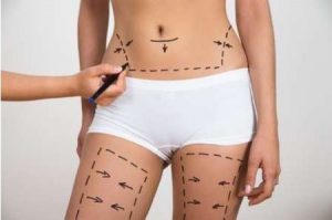 Tummy Tuck
