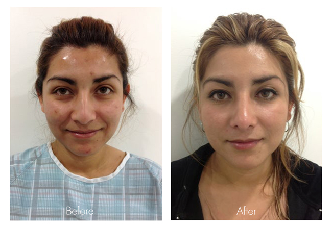 Rhinoplasty Cost: Understanding the Factors that Affect the Price of a Nose Job