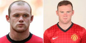 Rooney Hair Transplant