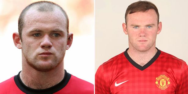 Rooney Hair Transplant
