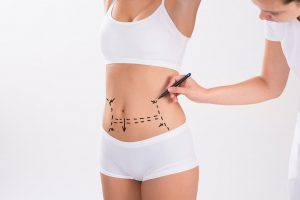 Liposuction
