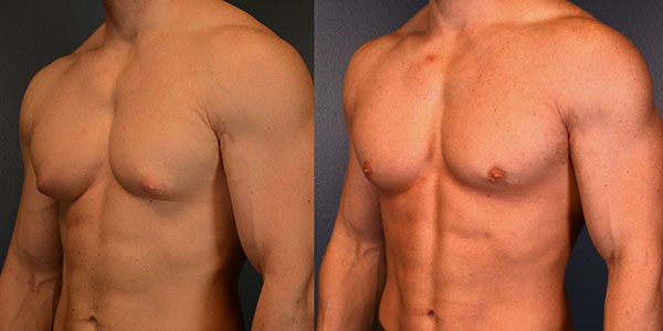 gynecomastia operation before after