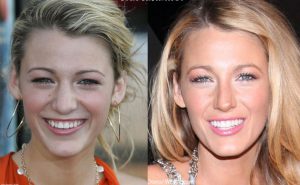 Blake Lively Nose Job