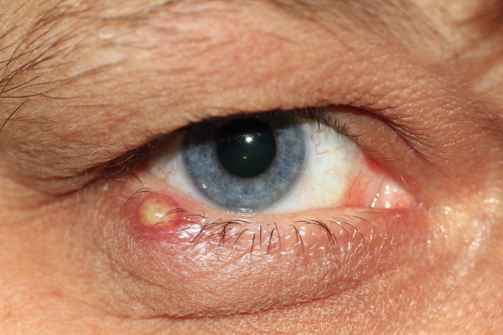 Introduction to Eyelid Sores