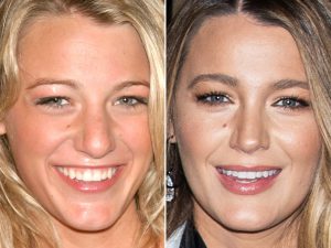 blake-lively-before-and-after