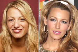 blake-lively-nose-job 2