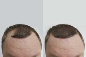 Hair Transplant DHI