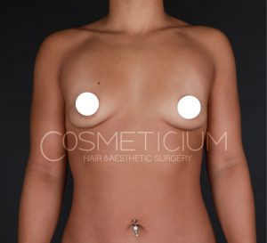 boob job before after-05-min