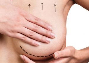 Breast Uplift