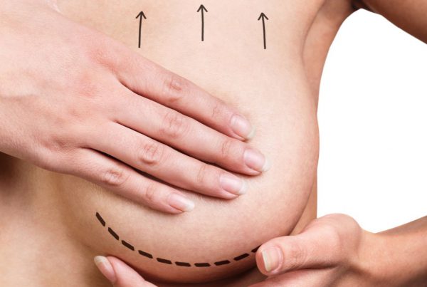Breast Uplift