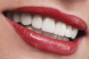 teeth whitening