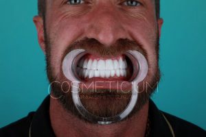dental treatment in turkey