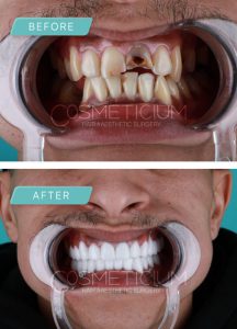dental treatments in turkey before after photos-01 (Medium)-min