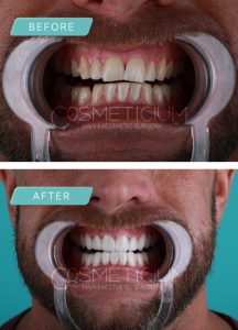 dental treatments in turkey before after photos-02 (Medium)-min