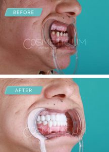 dental treatments in turkey before after photos-03 (Medium)-min