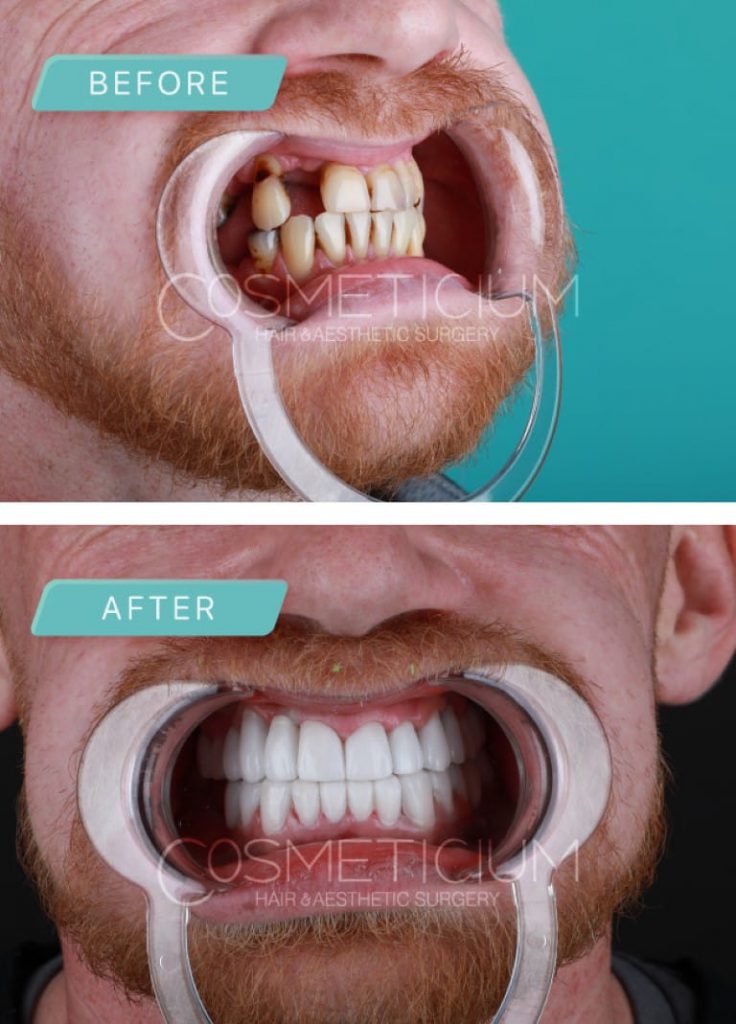 Dental Treatments Packages in Turkey Dental Centre Turkey Cosmeticium