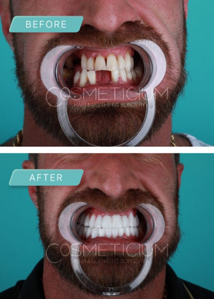 Dental Treatments Packages in Turkey Dental Centre Turkey Cosmeticium