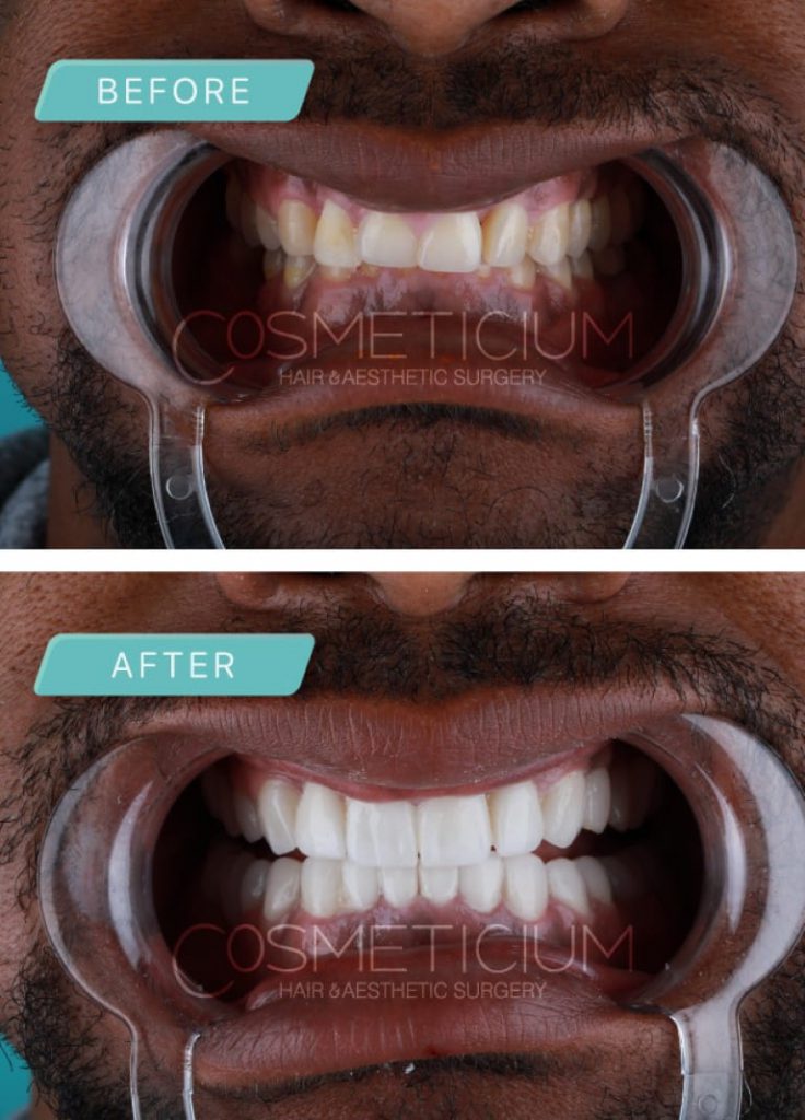 Dental Treatments Packages in Turkey Dental Centre Turkey Cosmeticium