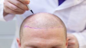 Hair Transplant