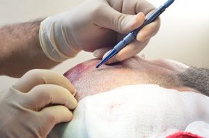 hair Transplant