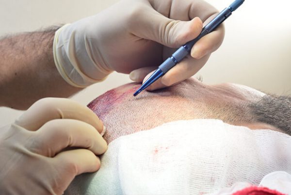 hair Transplant