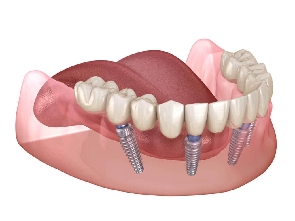 Dental İmplant