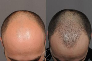 Hair Transplant