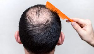 Hair Transplant