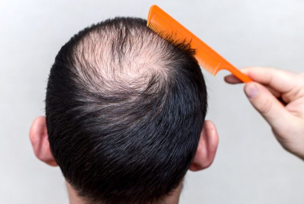 Hair Transplant