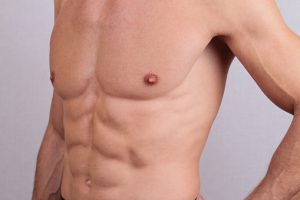 gynecomastia