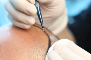Hair Transplant