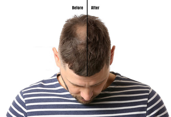hair transplant Before After