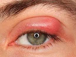 Introduction to Eyelid Sores