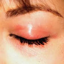 Introduction to Eyelid Sores