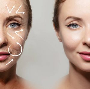 Facelift Before After