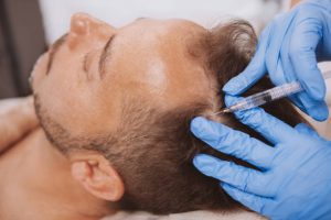PRP injection after hair transplant