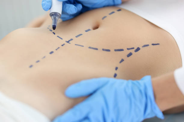Doctor plastic surgeon drawing preoperative markings on skin of patient abdomen closeup. Plastic surgery and aesthetic medicine liposuction concept