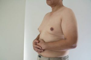 gynecomastia surgery