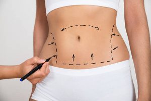 Liposuction İn Turkey