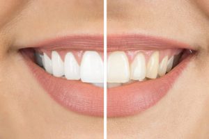 teeth whitening