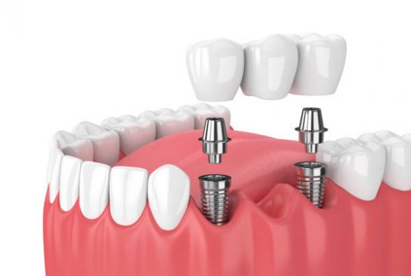 dental Implant