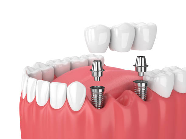 Dental Implant Procedure: A Comprehensive Guide