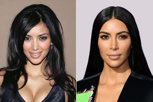 kim kardashian nose job Before After