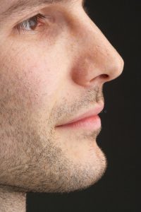 Rhinoplasty