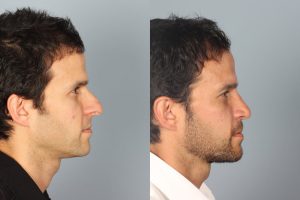 Rhinoplasty