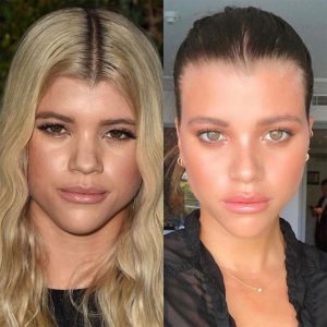 sofia richie Rhinoplasty Operation