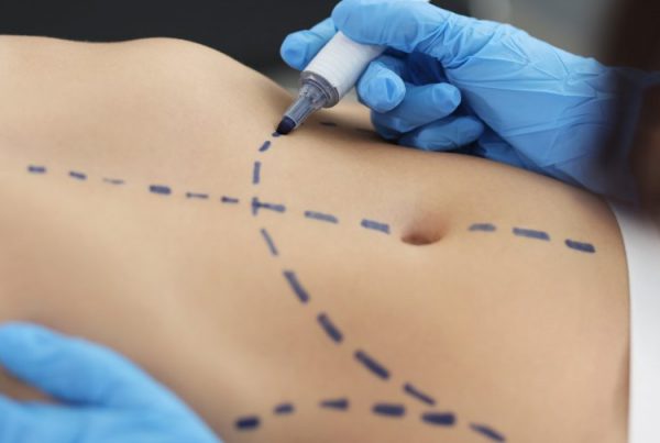 Tummy Tuck