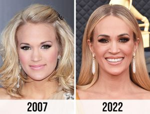 Carrie Underwood nose job before after