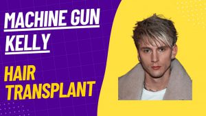 mgk hair transplant