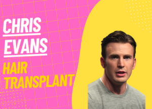 chris evans hair transplant operation